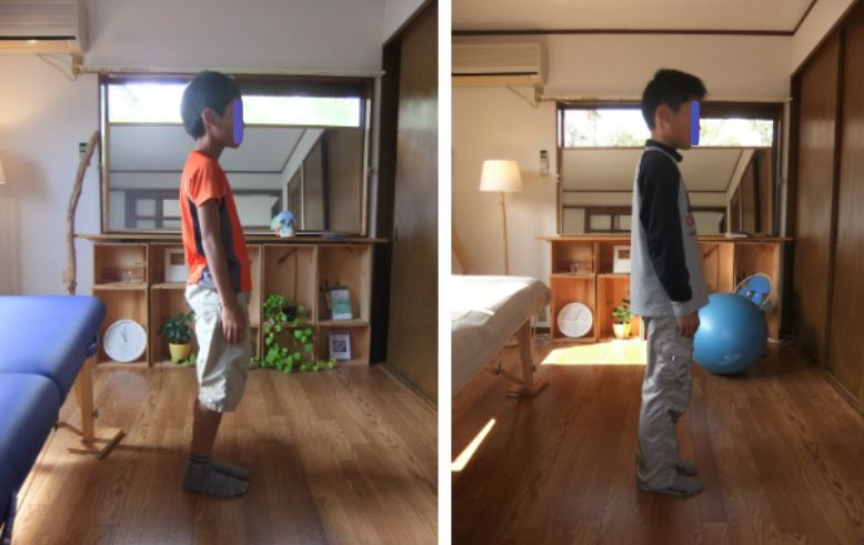 芦屋の子ども整体 姿勢改善ビフォーアフター 症例3 - Ease Garden